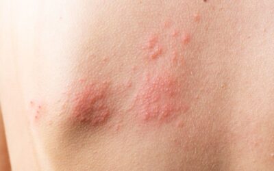 5 Common Minor Skin Lumps and Bumps and How to Treat Them